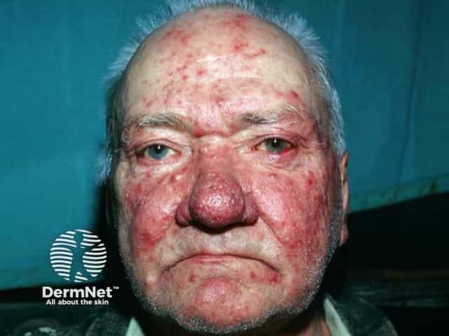 Severe papulopustular rosacea with a rhinophyma