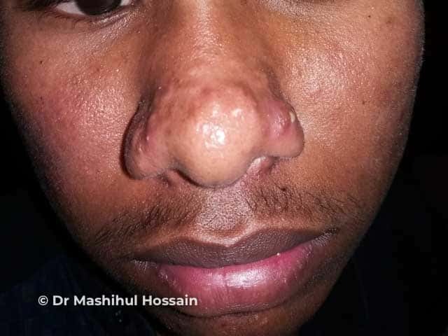 Rhinophyma 