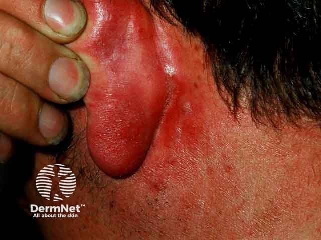 Retroauricular rosacea