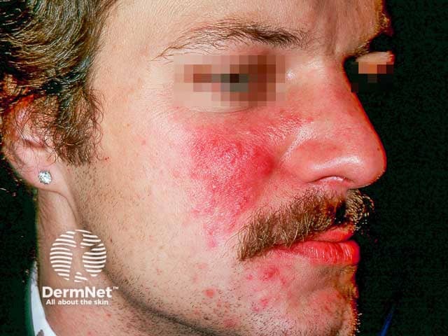 Erythematotelangiectatic and papulopustular rosacea on the cheeks