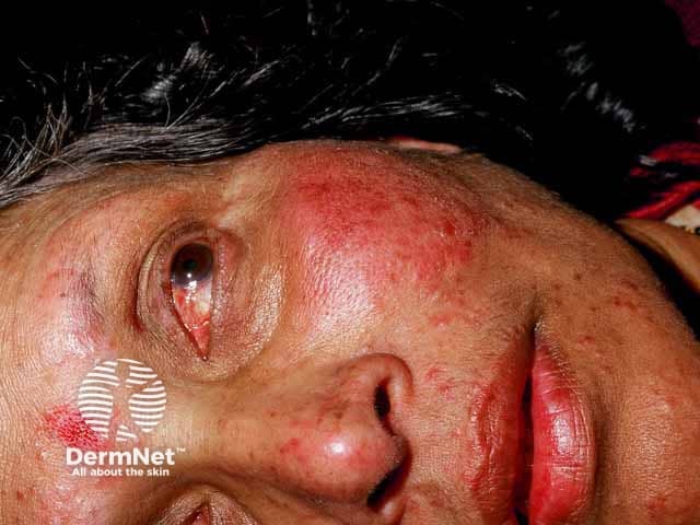 Papulopustular and ocular rosacea