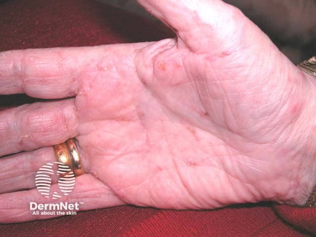 Numerous palmar scabies burrows in an elderly lady