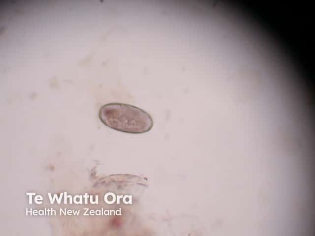 A scabies egg extracted from a burrow