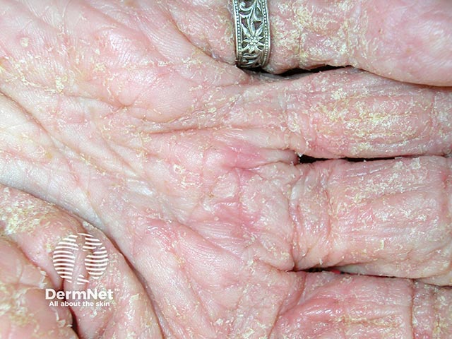 Early crusted scabies on the palm