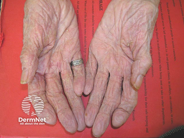 Early crusted scabies on the palms