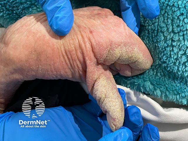 Gross crusting on the thumb and fingers in a care-home resident with dementia