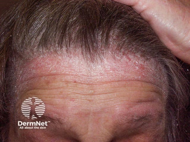 Psoriasis extending from the scalp into the anterior hair line