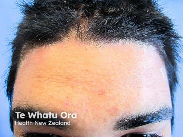 Psoriasis around the anterior hairline