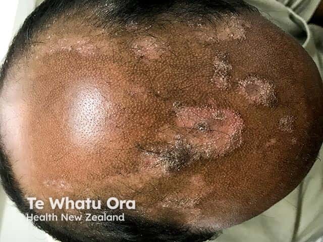 Well-defined scaly patches of psoriasis on the bald scalp in an Indian man