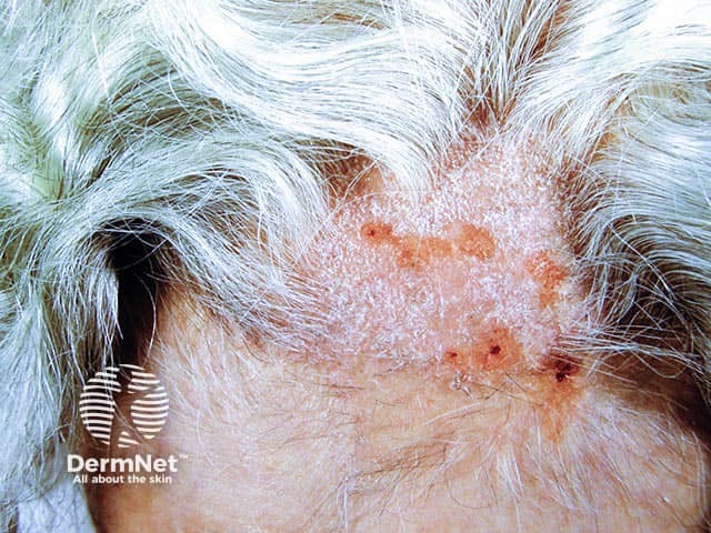 Excoriated scalp psoriasis resulting in an area of localised hair loss - note the short broken hairs from rubbing