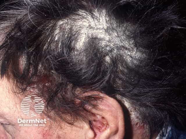 Extensive scaling over the parietal scalp due to psoriasis. There is psoriasis also in the ears and around the hair line