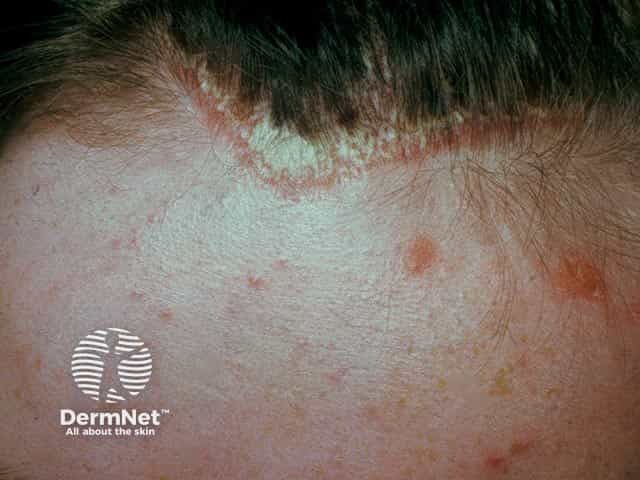 Well-circumscribed orange-red scaly plaque psoriasis extending forward from the anterior hairline