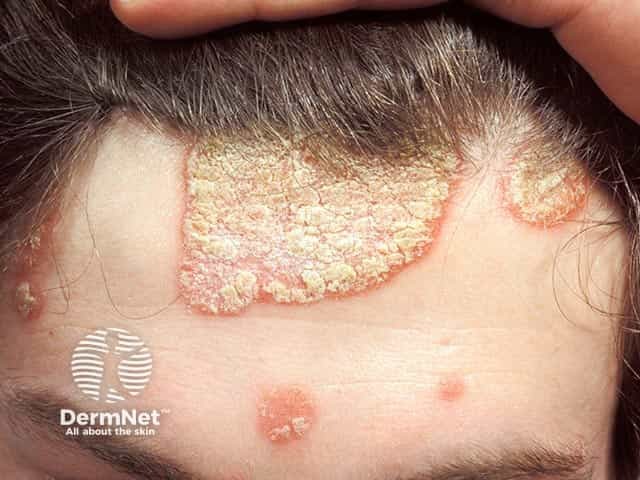 Hyperkeratotic psoriasis extending from the scalp to the forehead - note the distinct defined border