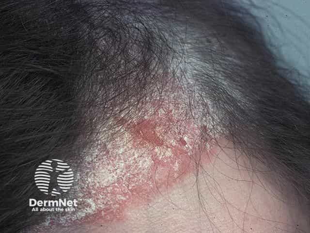 Scalp psoriasis extending beyond the anterior hairline