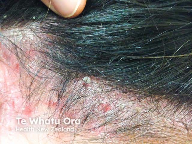 Scalp psoriasis extending onto the nape of the neck