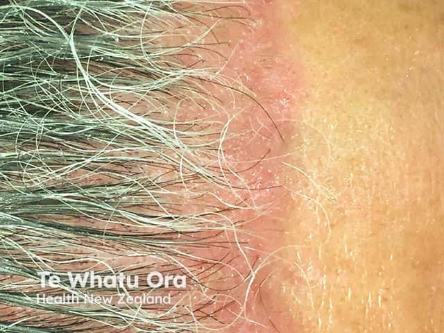 Psoriasis on the anterior hairline 