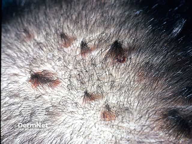 Small plaque psoriasis in the scalp showing teepee sign