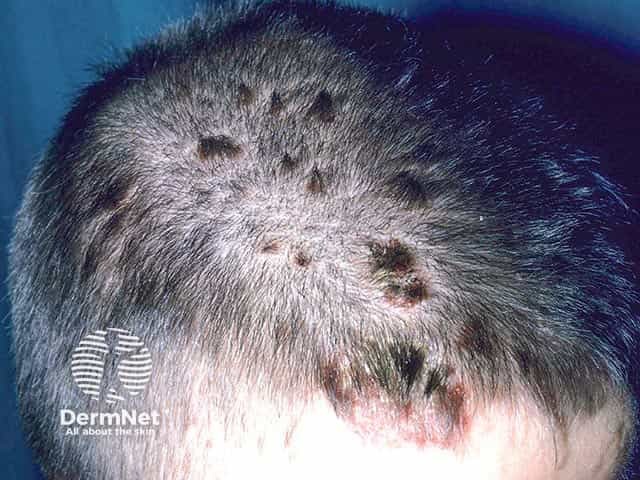 Small plaque psoriasis in the scalp showing teepee sign