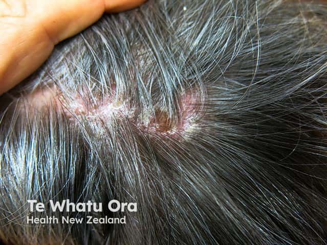 Excoriated psoriasis on the scalp