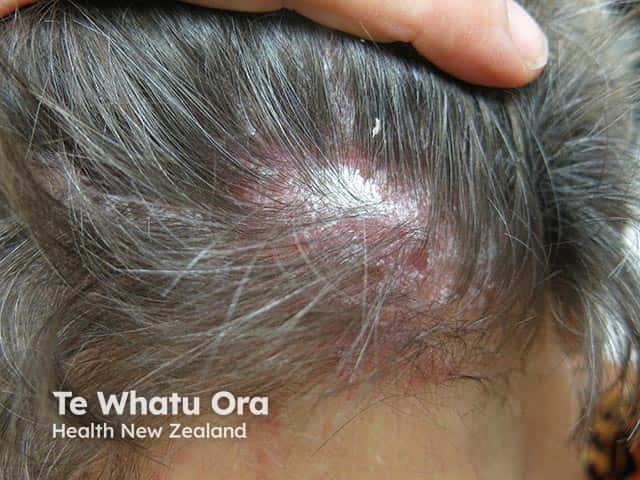 The classical silvery scale overlying scalp psoriasis