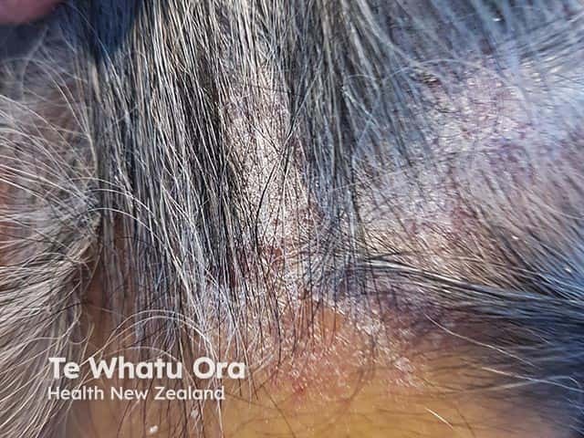 The classical silvery scale overlying scalp psoriasis