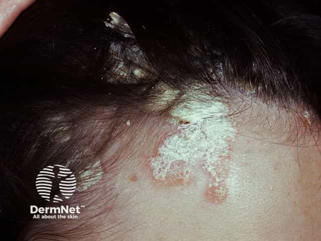 Well-demarcated scaly patches of psoriasis on the scalp and hairline