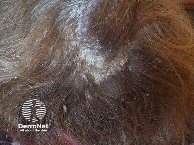 A well-defined patch of hyperkeratotic scalp psoriasis