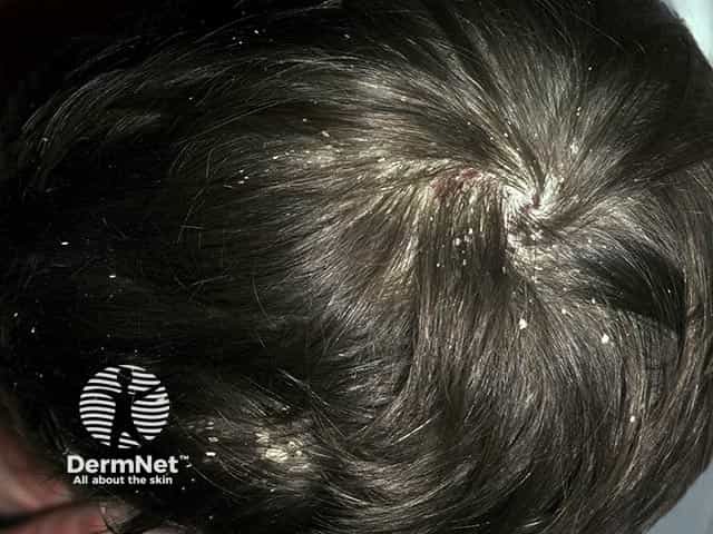 Marked scaling in psoriasis of the scalp