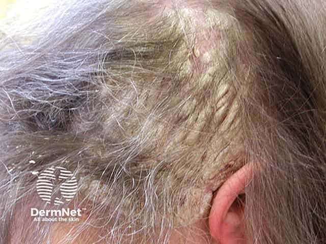 Severe hyperkeratotic scalp psoriasis