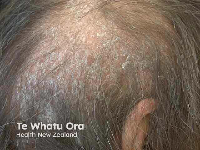 Scalp psoriasis with diffuse hair loss