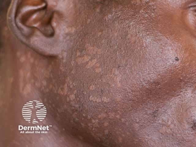 Hypopigmented seborrhoiec dermatitis in HIV