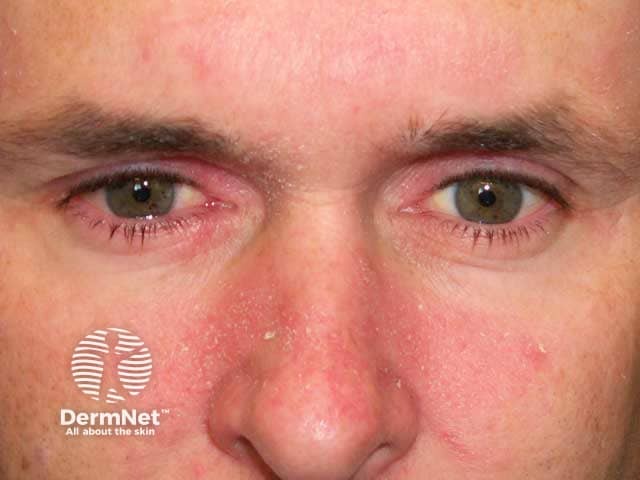 Seborrhoeic blepharitis and dermatitis on the cheeks