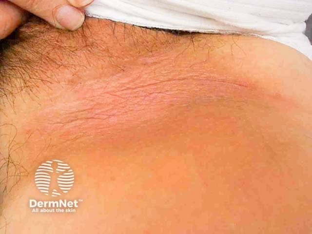 Crural fold seborrhoeic dermatitis