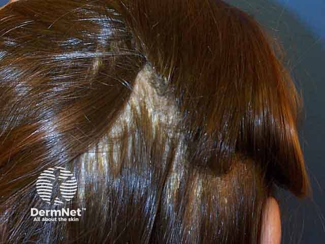 Overlapping scale in severe scalp seborrhoeic dermatitis