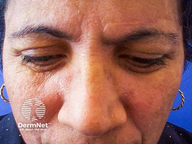 Erythema and scale in the brows, glabella and nasolabial folds