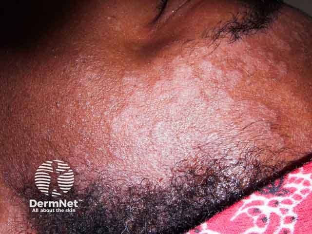 Seborrhoeic dermatitis around the hair line and forehead in skin of colour