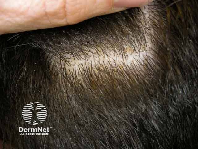 Honey-coloured scale in scalp seborrhoeic dermatitis