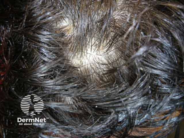 Scale and dandruff in seborrhoeic dermatitis