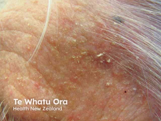 Greasy scale at the hairline in seborrhoeic dermatitis