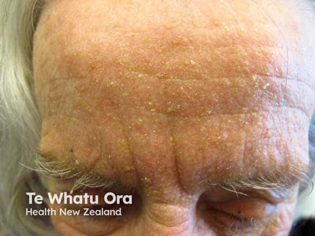 Yellow scale in forehead seborrhoeic dermatitis