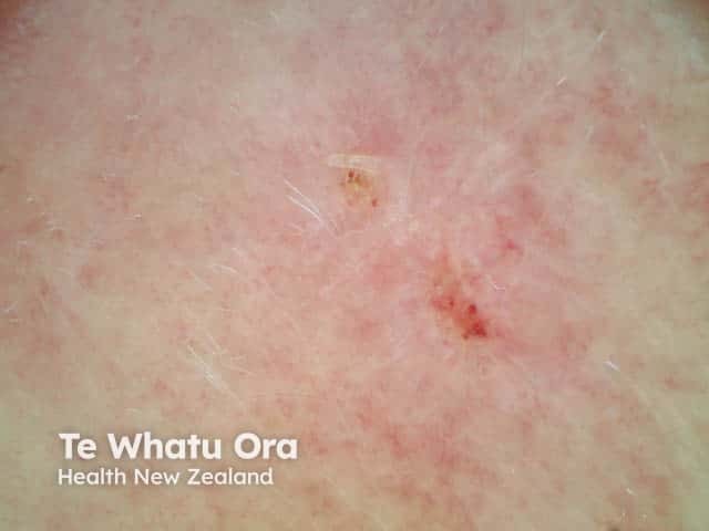 Dermoscopy of cheek seborrhoeic dermatitis