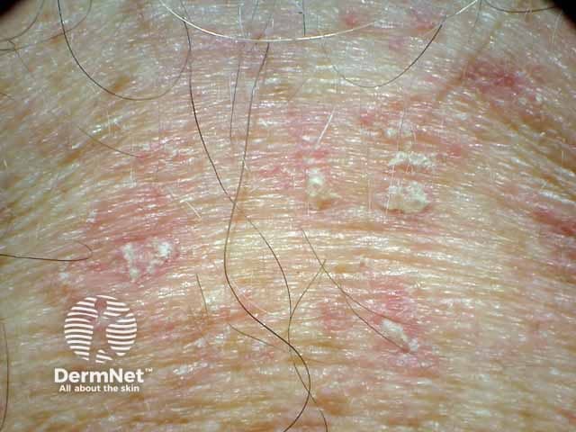 Presternal erythema and scale in seborrhoeic dermatitis