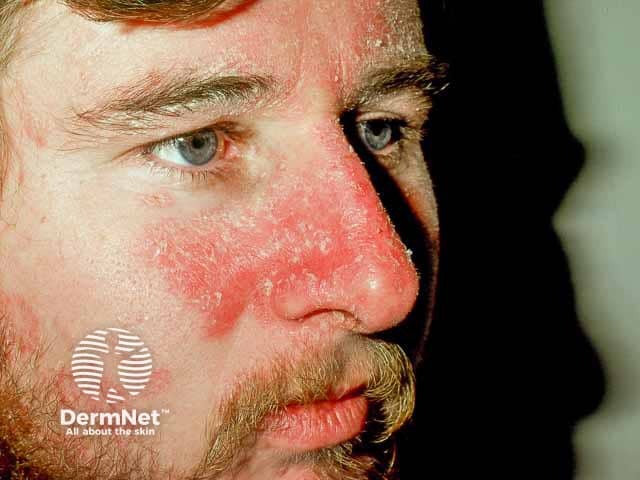 Marked erythema in cheek seborrhoeic dermatitis