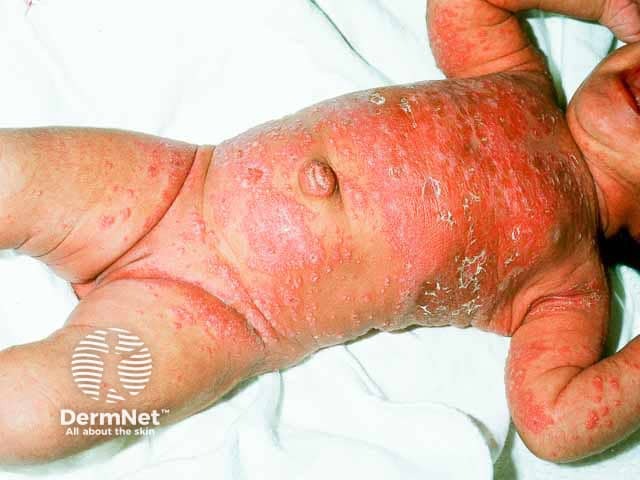 Widespread infantile seborrhoeic dermatitis