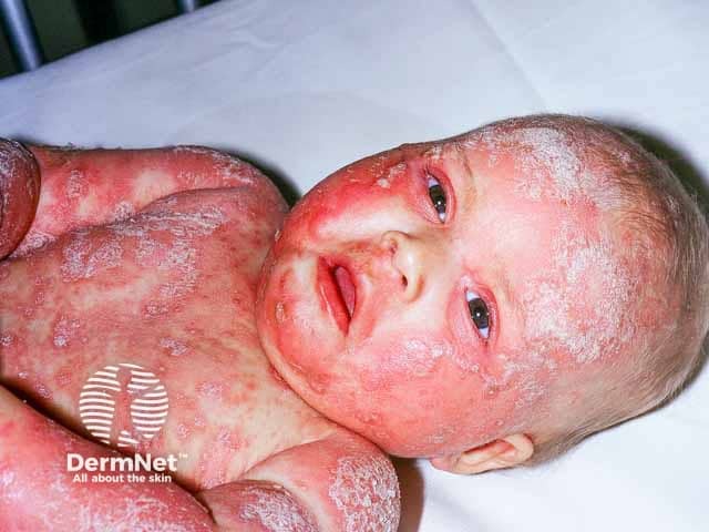 Extensive infantile seborrhoeic dermatitis