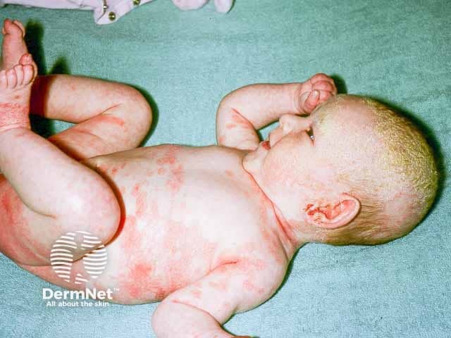 Infantile seborrhoeic dermatitis - note eczema in the napkin area and axillae and crade cap