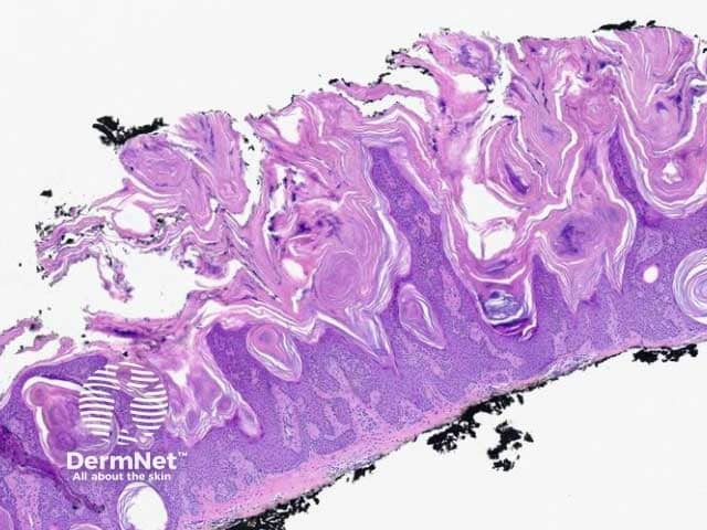 Figure 2: keratotic papillomatous pattern