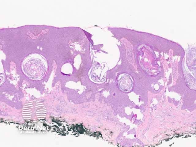 Figure 1: regular acanthotic seborrhoeic keratosis