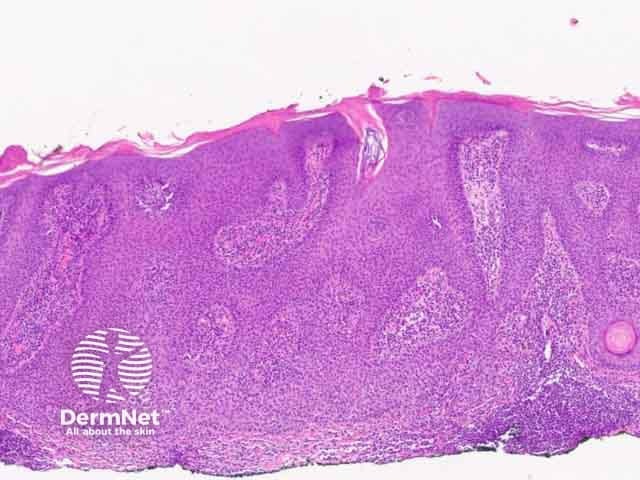 Figure 7: inflamed pattern