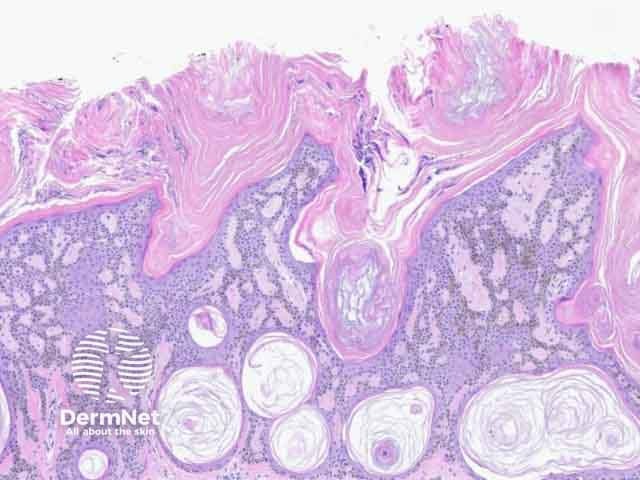 Figure 3: reticulated adenoid pattern